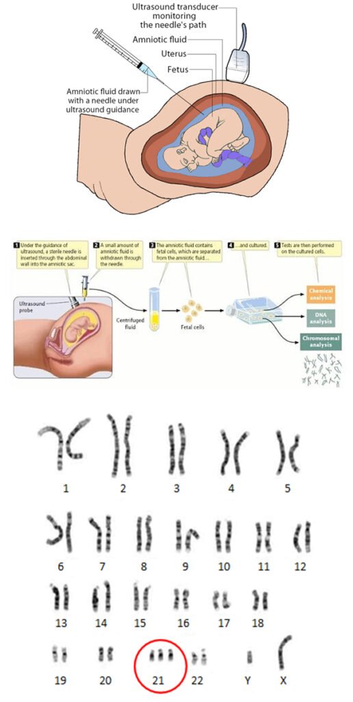 amniocentesis1 516x1024 1