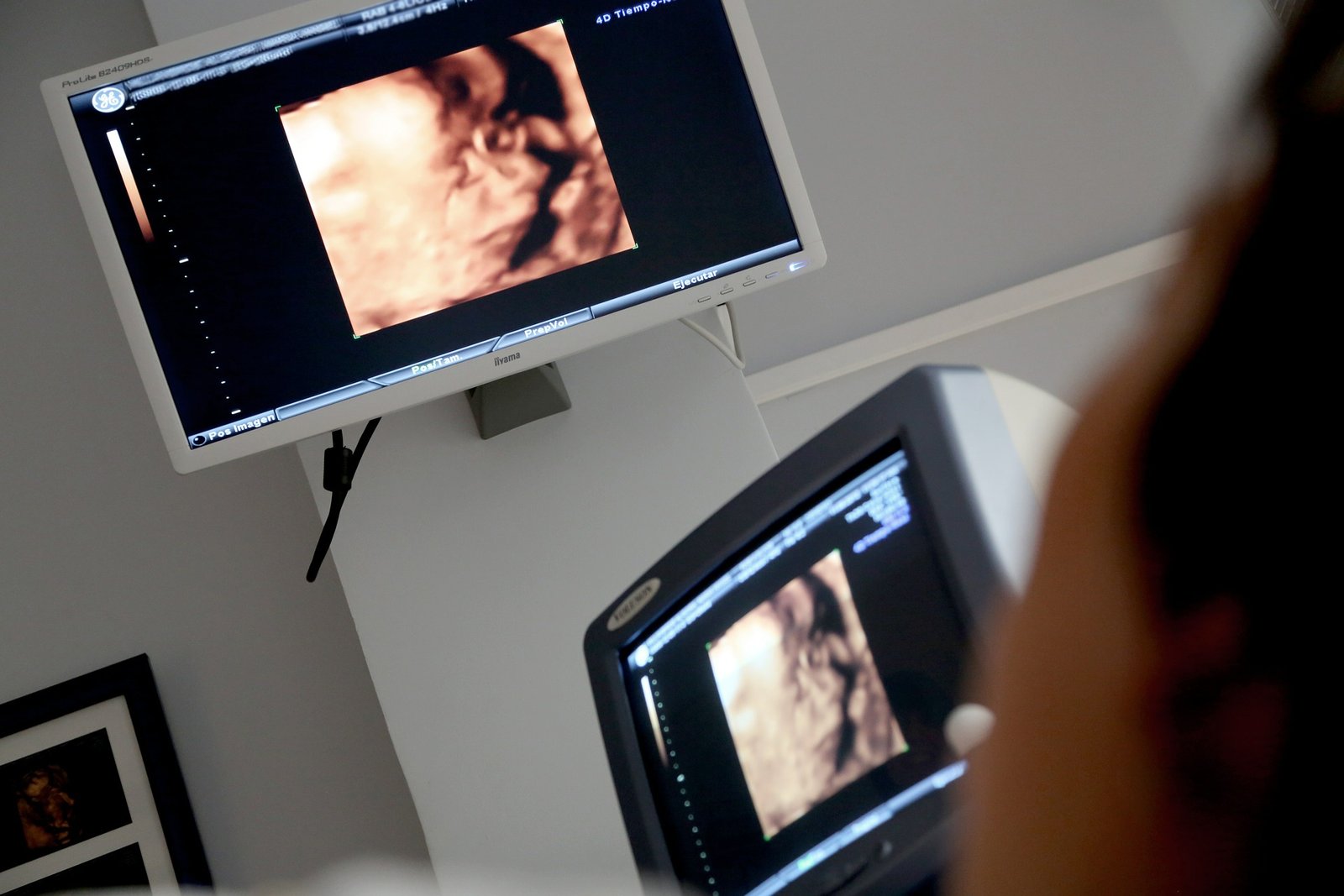 ultrasound scan during pregnancy