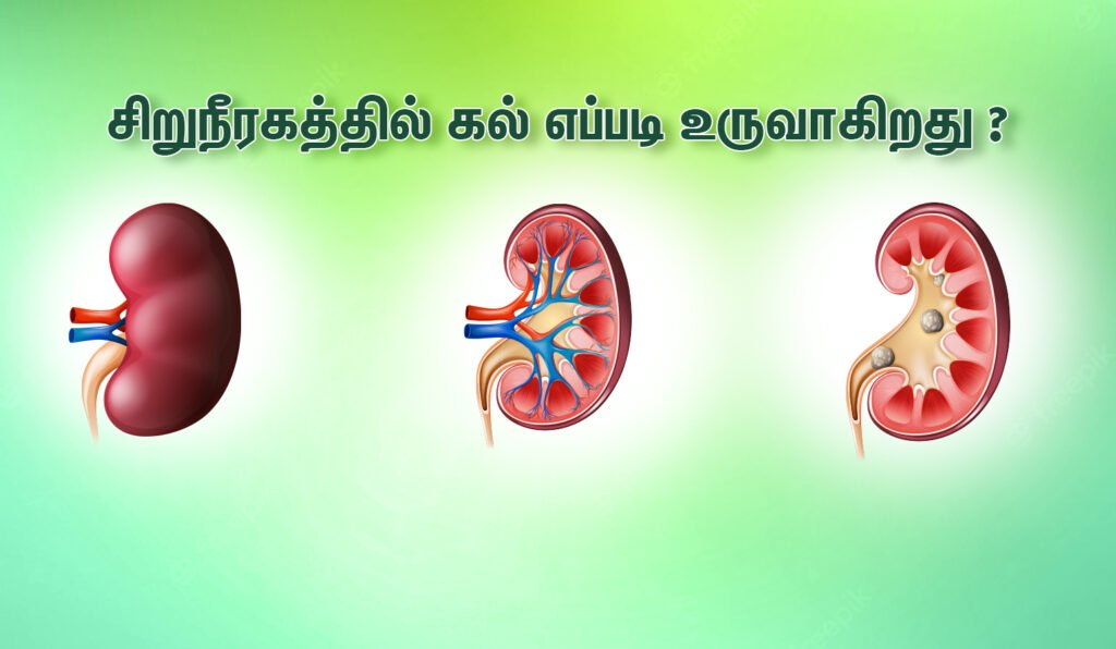 சிறுநீரக கற்கள் அறிகுறிகள், அதற்கான சிகிச்சை முறைகள் என்ன! 3 How Do Kidney Stones Form