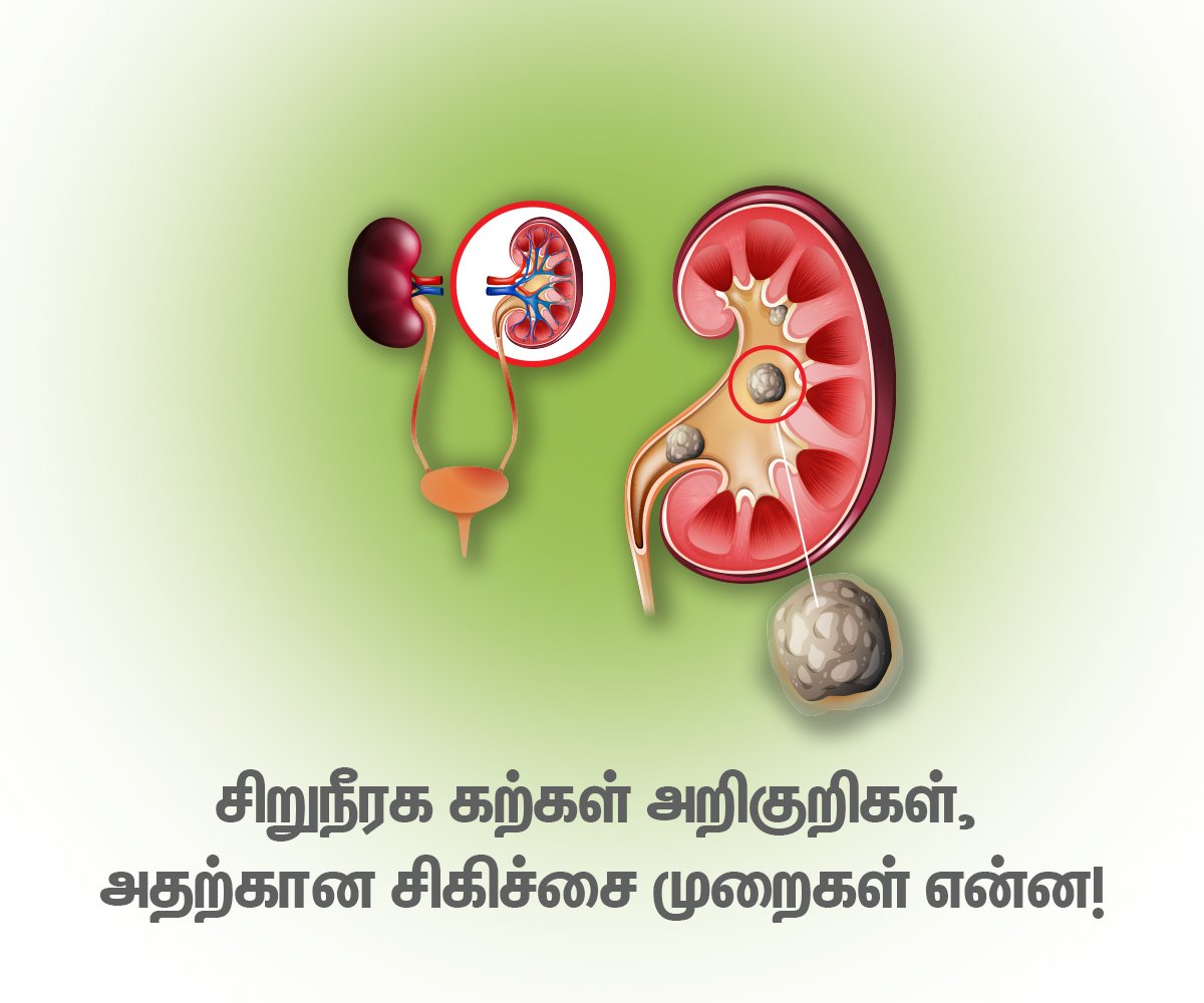 Kidney Stone Treatment