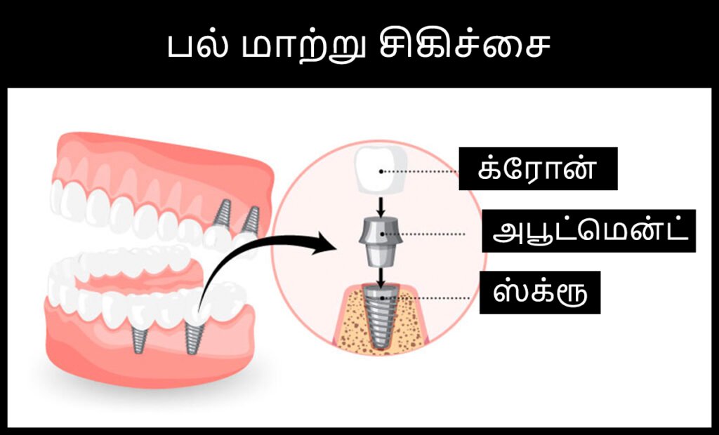 பல் வலியில் இருந்து விடுபட எளிய வழிகள்! 6 Tooth Decay Stages