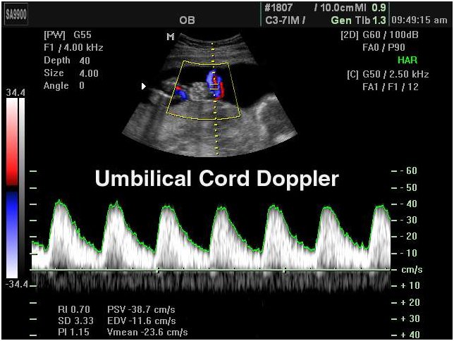 Umbilical Cord Doppler